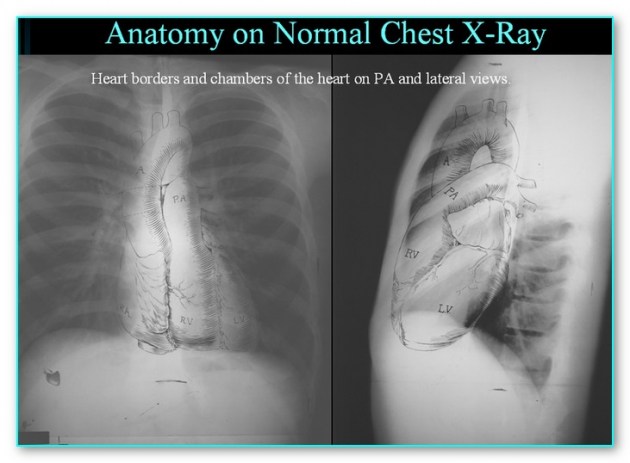 One of the most important images in all of clinical medicine: anatomy of the PA and lateral chest radiograph