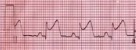 How to distinguish pericarditis from STEMI