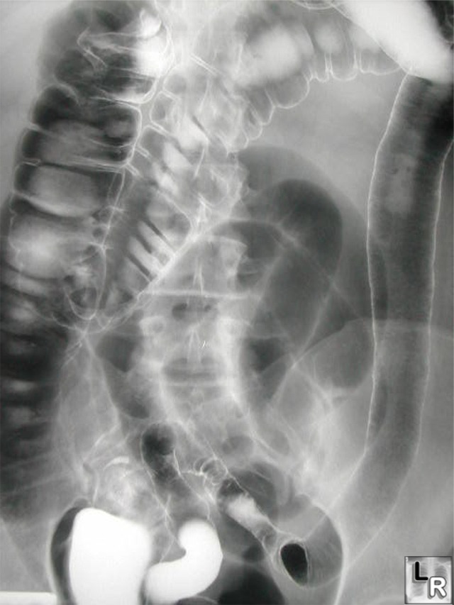 Inflammatory Bowel Disease: Crohn’s Versus Ulcerative Colitis